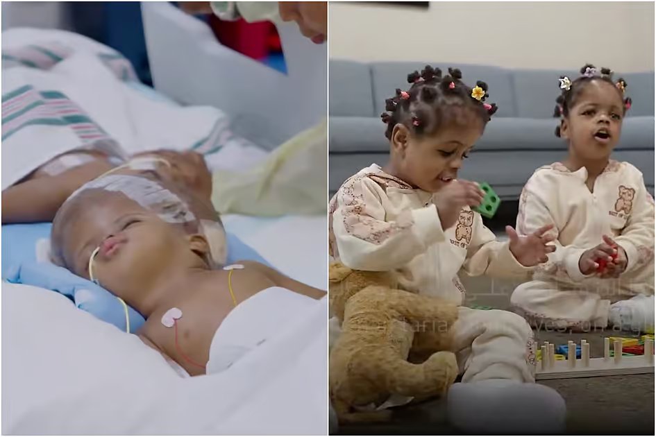 Video: Conjoined twins separated in 4 complex surgeries by Abu Dhabi hospital